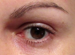 Eye Puffiness
