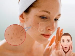 Dark Spots On Face