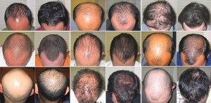Hair Loss Types