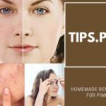 Homemade Remedies For Pimples